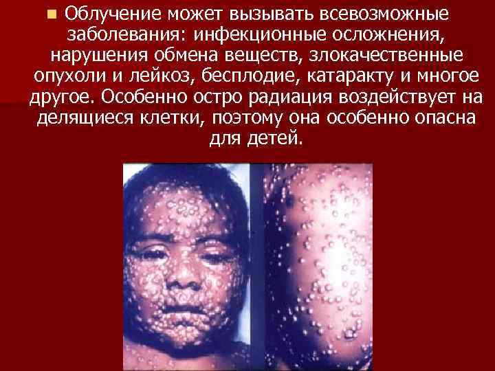 Облучение может вызывать всевозможные заболевания: инфекционные осложнения, нарушения обмена веществ, злокачественные опухоли и лейкоз,