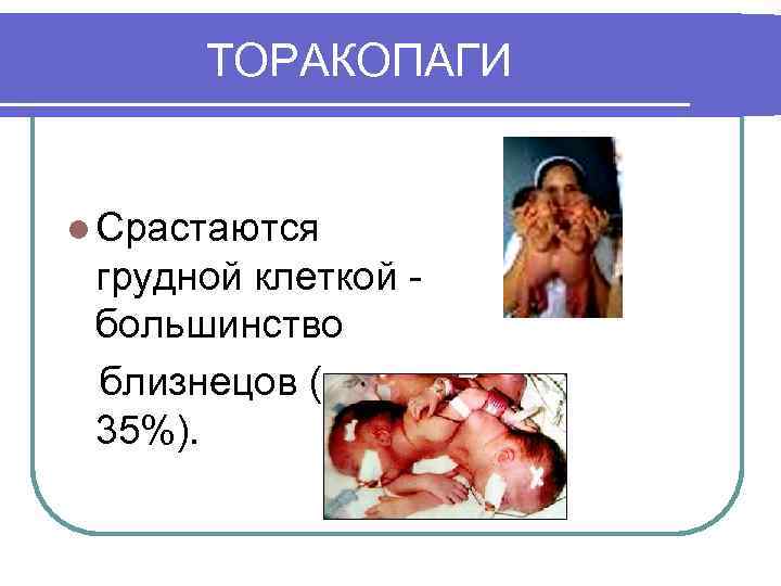 ТОРАКОПАГИ l Срастаются грудной клеткой большинство близнецов (около 35%). 