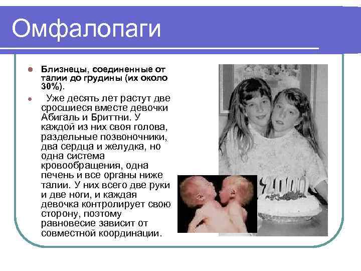 Омфалопаги l l Близнецы, соединенные от талии до грудины (их около 30%). Уже десять