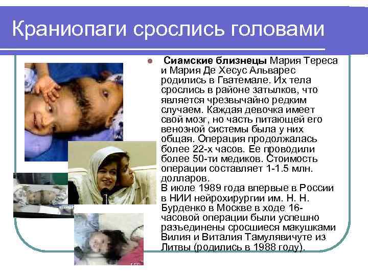 Краниопаги срослись головами l Сиамские близнецы Мария Тереса и Мария Де Хесус Альварес родились