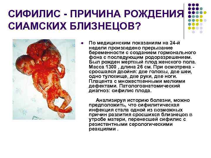 СИФИЛИС - ПРИЧИНА РОЖДЕНИЯ СИАМСКИХ БЛИЗНЕЦОВ? l По медицинским показаниям на 24 -й недели