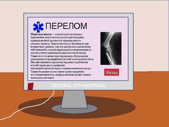 ПЕРЕЛОМ Перелом кости — полное или частичное нарушение целостности кости при нагрузке, превышающей прочность