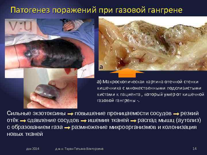 Патогенез поражений при газовой гангрене а) Макроскопическая картина отечной стенки кишечника с множественными подслизистыми