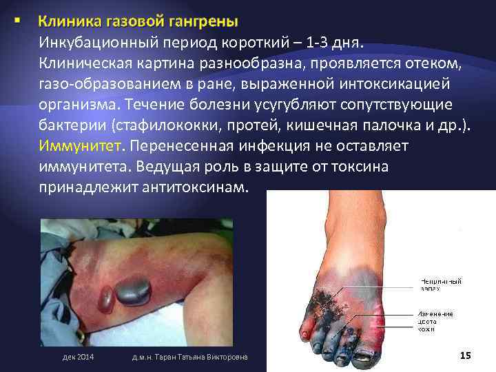 § Клиника газовой гангрены Инкубационный период короткий – 1 3 дня. Клиническая картина разнообразна,