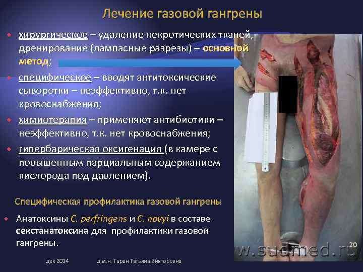 Лечение газовой гангрены хирургическое – удаление некротических тканей, дренирование (лампасные разрезы) – основной метод;