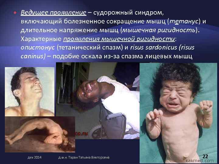  Ведущее проявление – судорожный синдром, включающий болезненное сокращение мышц (тетанус) и длительное напряжение