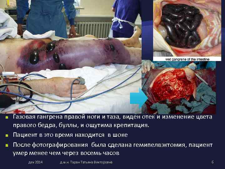 Газовая гангрена правой ноги и таза, виден отек и изменение цвета правого бедра, буллы,