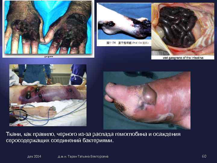 Ткани, как правило, черного из-за распада гемоглобина и осаждения серосодержащих соединений бактериями. дек 2014