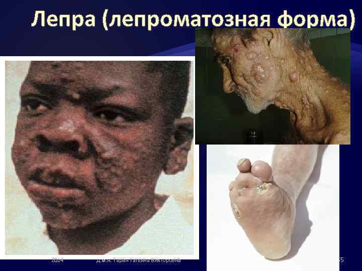 Лепра (лепроматозная форма) 2014 д. м. н. Таран Татьяна Викторовна 55 