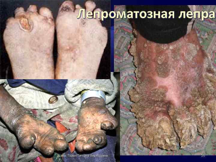 Лепроматозная лепра 2014 д. м. н. Таран Татьяна Викторовна 56 