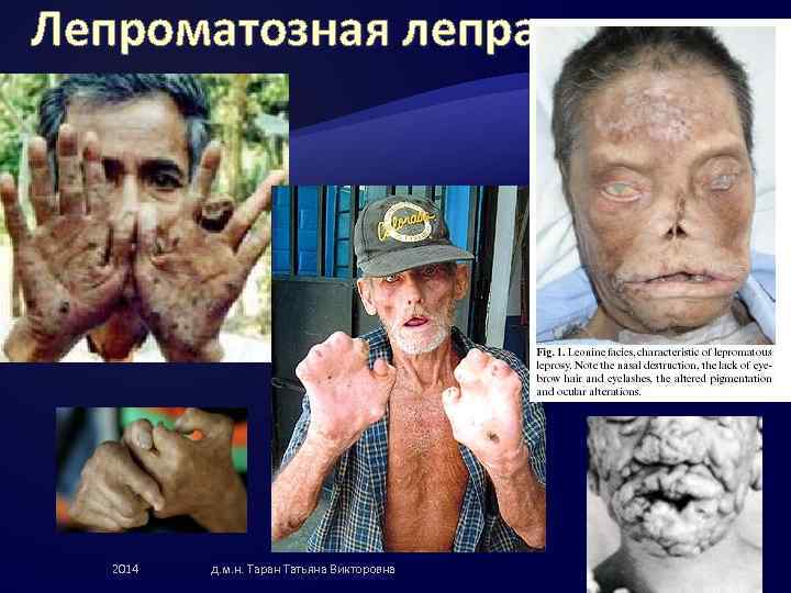 Лепроматозная лепра 2014 д. м. н. Таран Татьяна Викторовна 57 