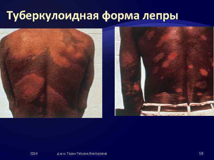 Туберкулоидная форма лепры 2014 д. м. н. Таран Татьяна Викторовна 58 