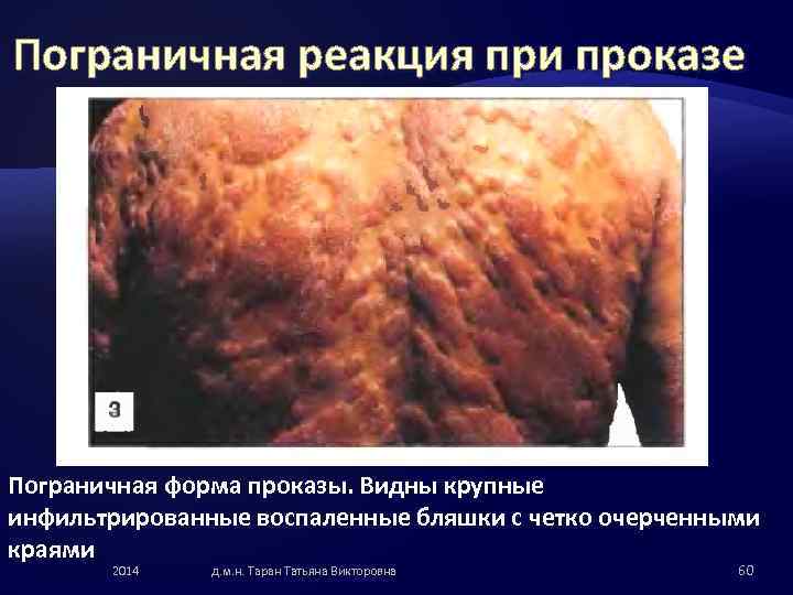 Пограничная реакция при проказе Пограничная форма проказы. Видны крупные инфильтрированные воспаленные бляшки с четко