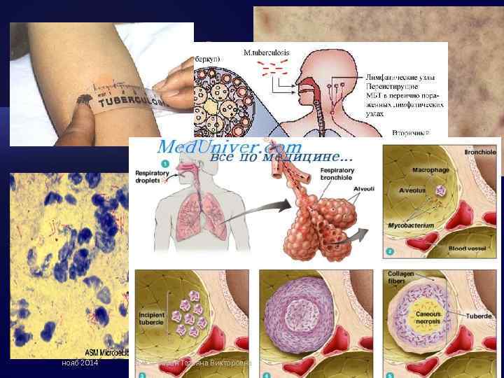 Acid-Fast Stain Mycobacterium tuberculosis нояб 2014 д. м. н. Таран Татьяна Викторовна 69 