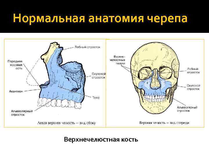 Нормальная анатомия черепа Верхнечелюстная кость 