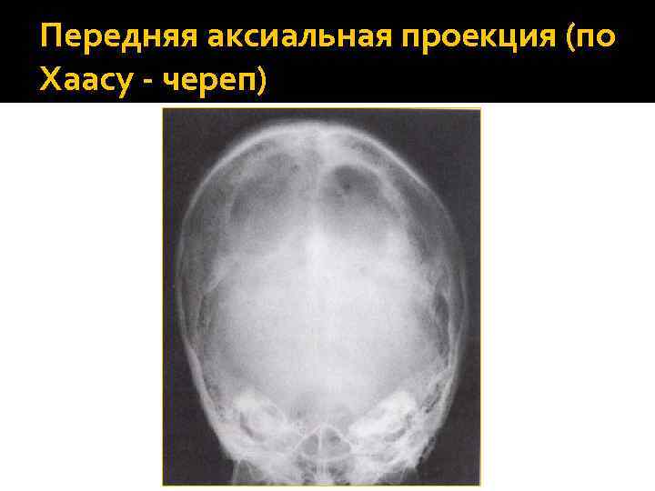 Передняя аксиальная проекция (по Хаасу - череп) 