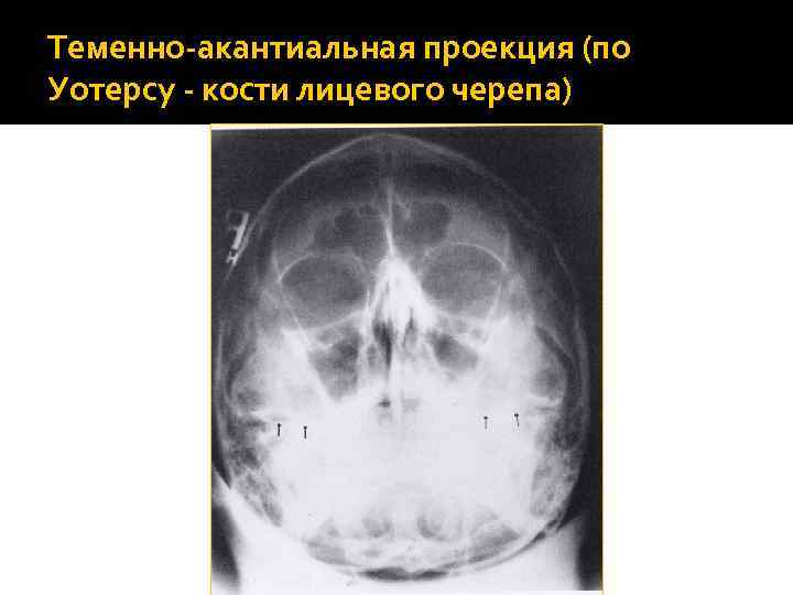 Теменно-акантиальная проекция (по Уотерсу - кости лицевого черепа) 