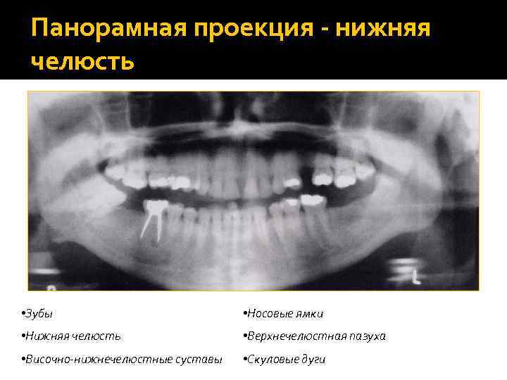 Панорамная проекция - нижняя челюсть • Зубы • Носовые ямки • Нижняя челюсть •