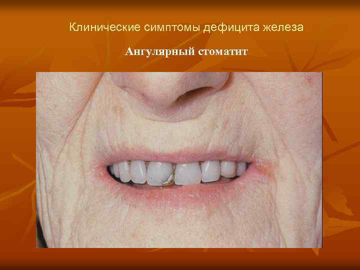 Клинические симптомы дефицита железа Ангулярный стоматит 