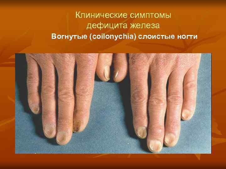 Клинические симптомы дефицита железа Вогнутые (coilonychia) слоистые ногти 