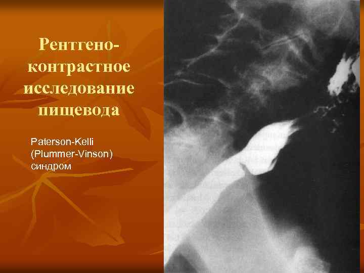 Рентгеноконтрастное исследование пищевода Paterson-Kelli (Plummer-Vinson) синдром 
