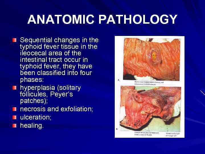 ANATOMIC PATHOLOGY Sequential changes in the typhoid fever tissue in the ileocecal area of