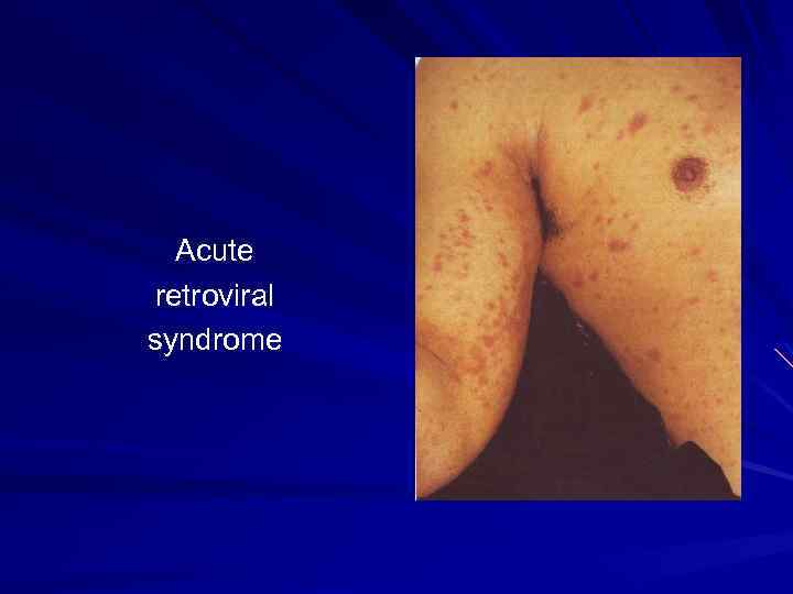 Acute retroviral syndrome 