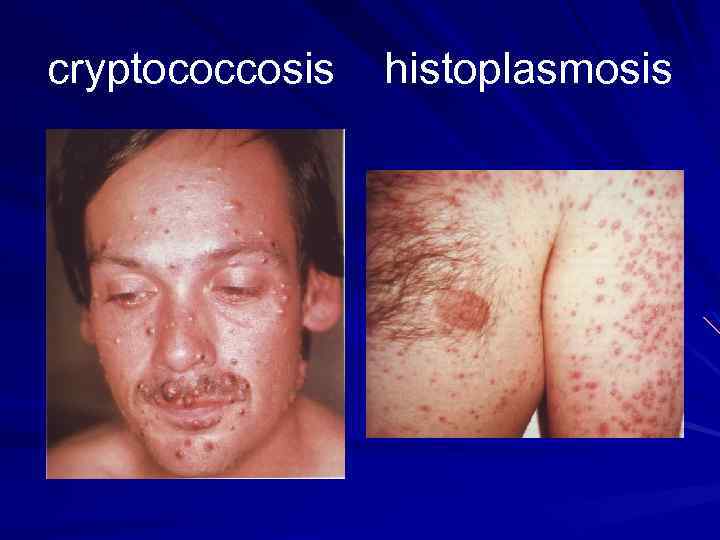 cryptococcosis histoplasmosis 