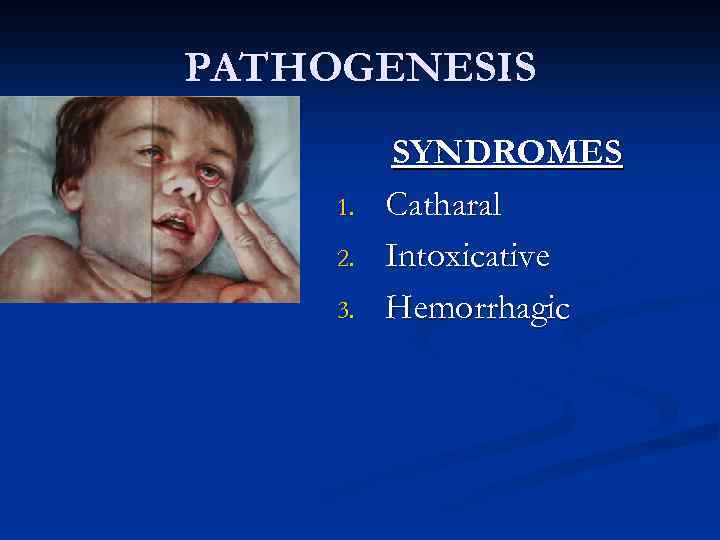 PATHOGENESIS 1. 2. 3. SYNDROMES Catharal Intoxicative Hemorrhagic 