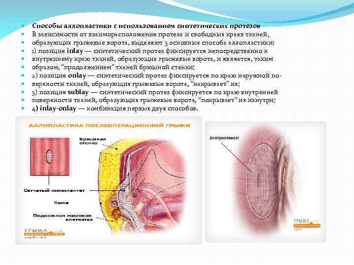  Способы аллопластики с использованием синтетических протезов В зависимости от взаиморасположения протеза и свободных
