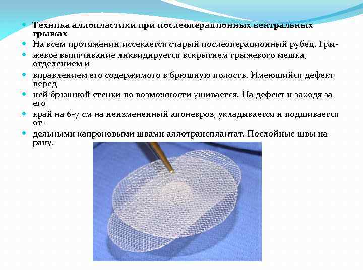  Техника аллопластики при послеоперационных вентральных грыжах На всем протяжении иссекается старый послеоперационный рубец.
