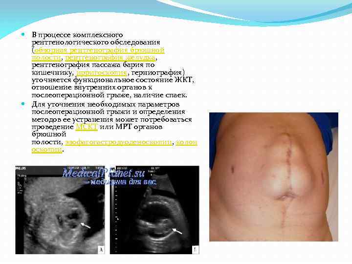  В процессе комплексного рентгенологического обследования (обзорная рентгенография брюшной полости, рентгенография желудка, рентгенография пассажа