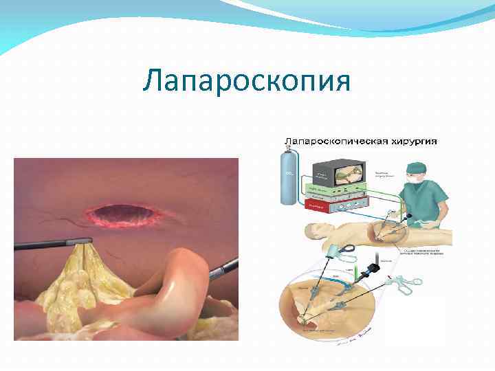 Лапароскопия 