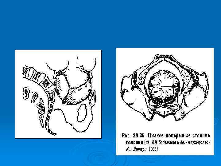 Анатомически и клинически узкий таз презентация