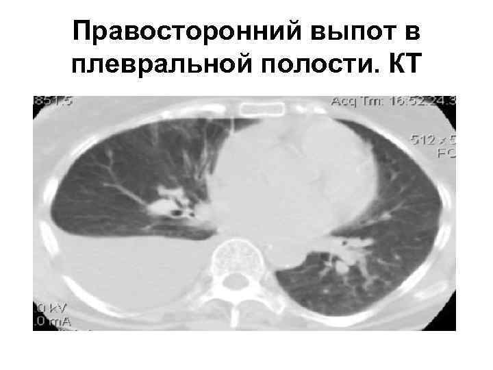 Правосторонний выпот в плевральной полости. КТ 