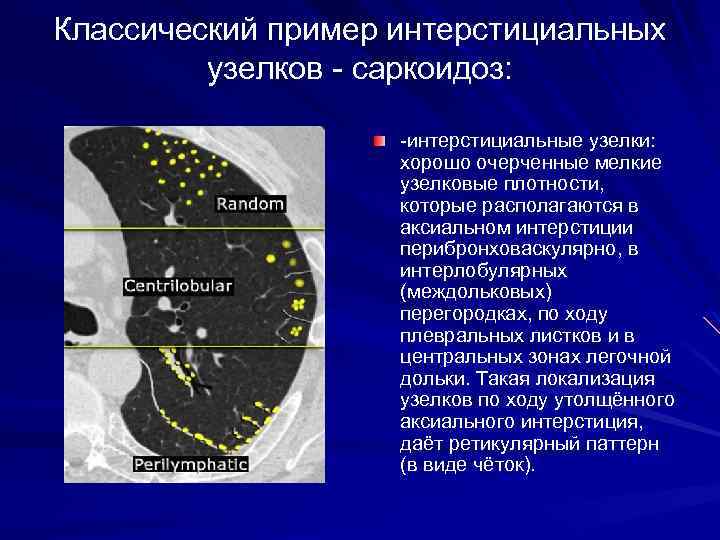 Классический пример интерстициальных узелков - саркоидоз: -интерстициальные узелки: хорошо очерченные мелкие узелковые плотности, которые