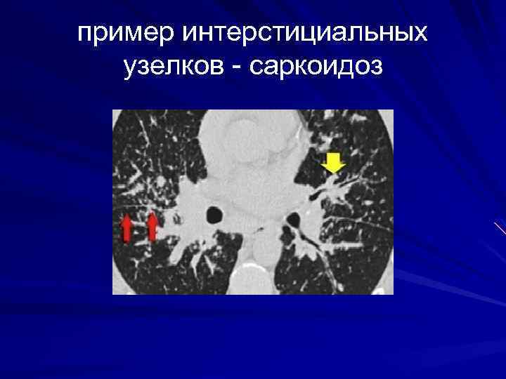 пример интерстициальных узелков - саркоидоз 