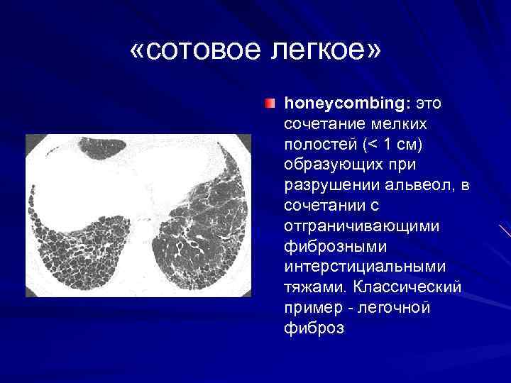  «сотовое легкое» honeycombing: это сочетание мелких полостей (< 1 см) образующих при разрушении