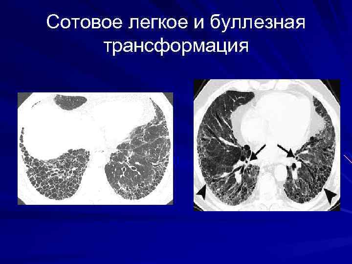 Деформация легочного рисунка по мелкоячеистому типу