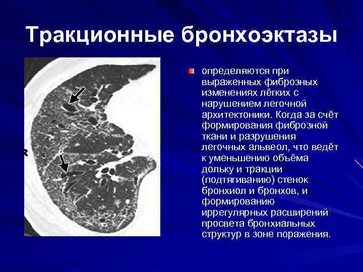 Фиброзно изменен легочный рисунок что это значит