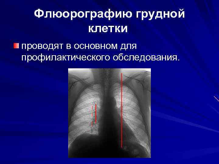 Флюорографию грудной клетки проводят в основном для профилактического обследования. 