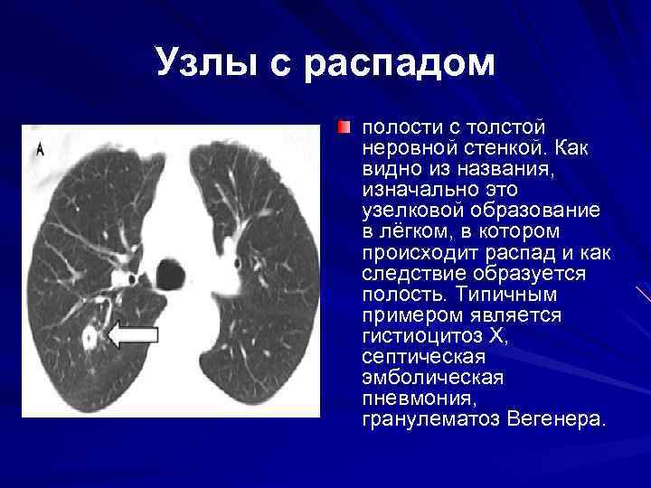 Узлы с распадом полости с толстой неровной стенкой. Как видно из названия, изначально это