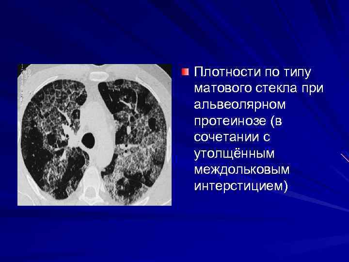 Плотности по типу матового стекла при альвеолярном протеинозе (в сочетании с утолщённым междольковым интерстицием)