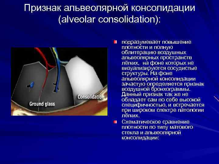 Признак альвеолярной консолидации (alveolar consolidation): подразумевает повышение плотности и полную облитерацию воздушных альвеолярных пространств