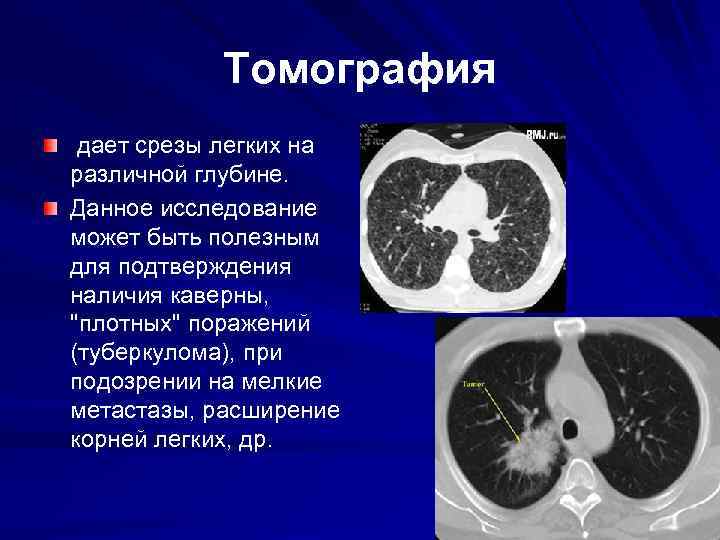 Томография дает срезы легких на различной глубине. Данное исследование может быть полезным для подтверждения