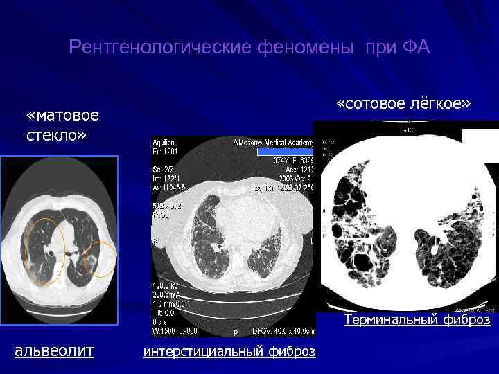 Рентгенологические феномены при ФА «сотовое лёгкое» «матовое стекло» Терминальный фиброз альвеолит интерстициальный фиброз 