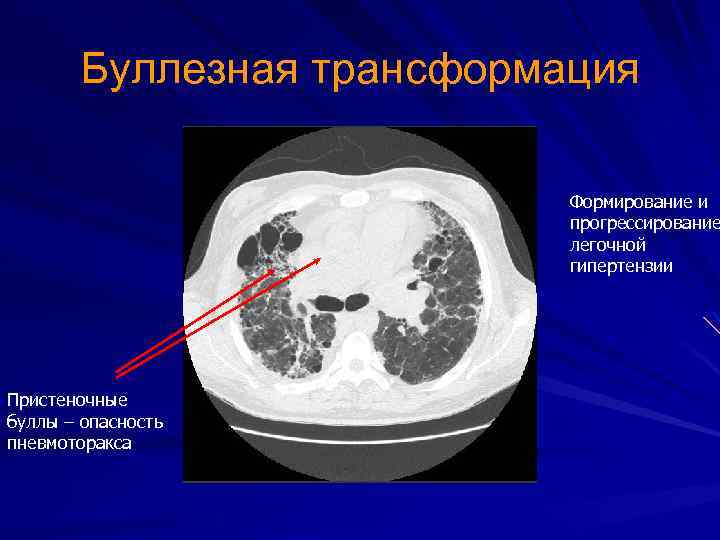 Буллезная трансформация Формирование и прогрессирование легочной гипертензии Пристеночные буллы – опасность пневмоторакса 