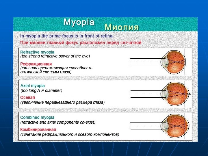 Миопия можно ли рожать. Близорукость осевая и рефракционная. Осевая миопия. Виды миопии.