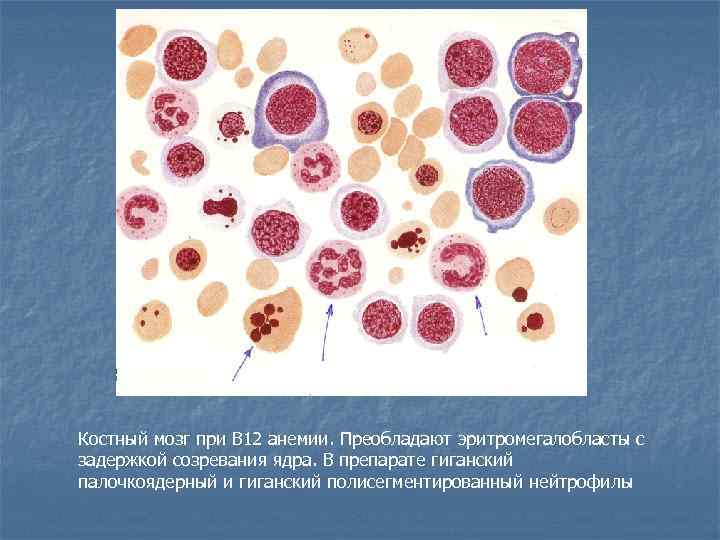 Костный мозг при В 12 анемии. Преобладают эритромегалобласты с задержкой созревания ядра. В препарате