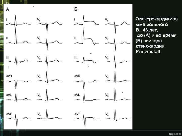 Электрокардиогра мма больного В. , 46 лет, до (А) и во время (Б) эпизода